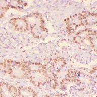 IHC_mouse breast cancer